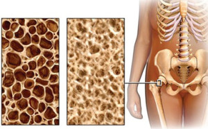 osteoporoza2